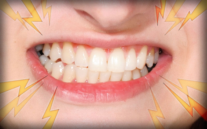 بهبود دندان قروچه با محصولات فوراور